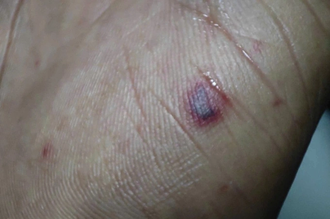 Tử ban trên tay bệnh nhân não mô cầu. Ảnh: Bệnh viện cung cấp