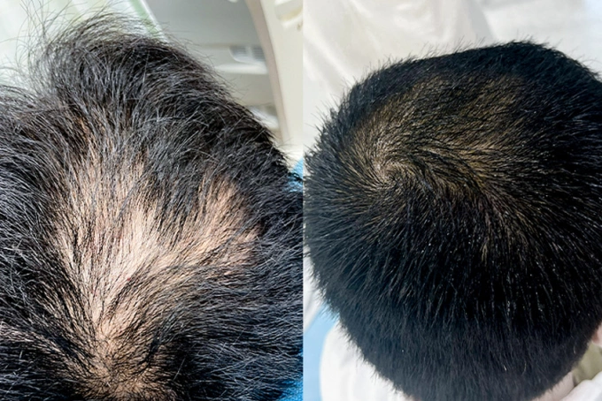 Tình trạng rụng tóc của anh Hưng cải thiện 70-80% sau 5 lần tiêm PRP. Ảnh: Bệnh viện Đa khoa Tâm Anh