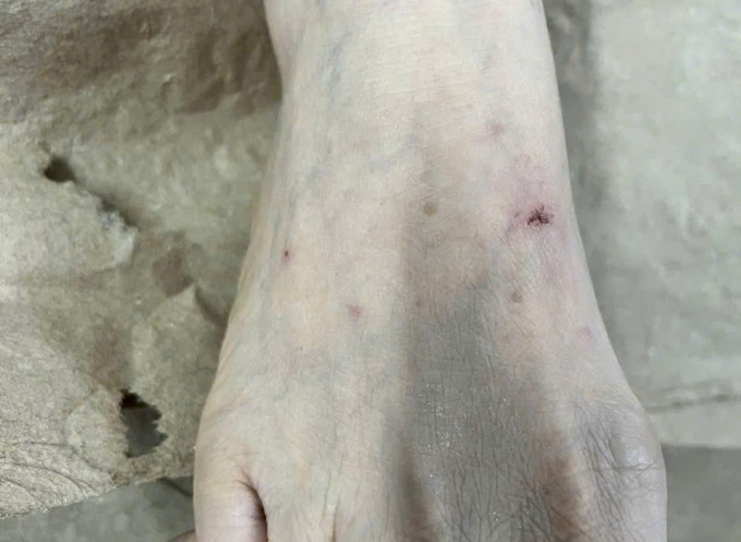 Bị mèo nhà cắn, bệnh nhân tự xử trí sai cách bằng việc nặn máu và bôi nước chanh lên vết thương. Ảnh: Bệnh viện cung cấp