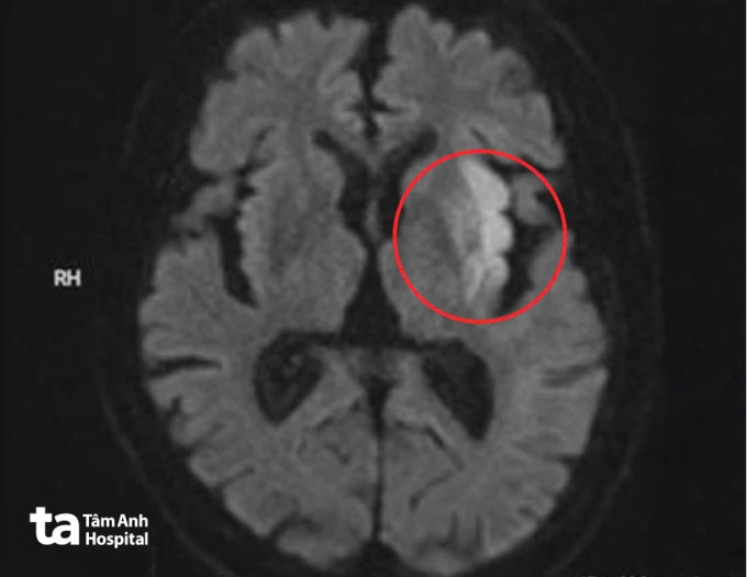 Ảnh MRI cho thấy vùng nhồi máu cấp diện rộng ở bán cầu não trái, ảnh hưởng vùng vận động và ngôn ngữ của ông Trung. Ảnh: Bệnh viện Đa khoa Tâm Anh
