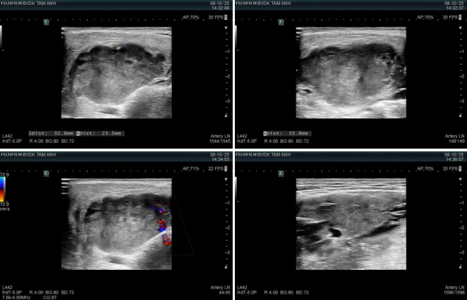 Ảnh siêu âm ghi nhận khối u tuyến mang tai bên phải của anh Thành. Ảnh: Bệnh viện Đa khoa Tâm Anh