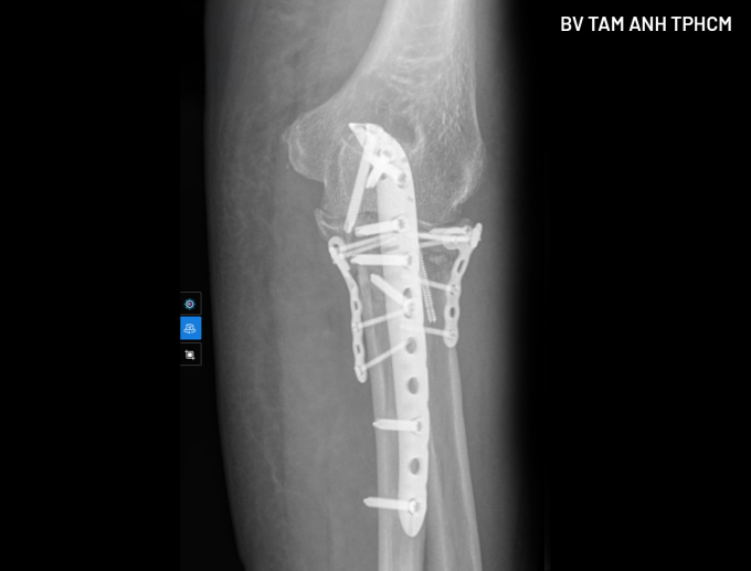 Kết quả chụp X-quang tay phải người bệnh sau phẫu thuật. Ảnh: Bệnh viện Đa khoa Tâm Anh