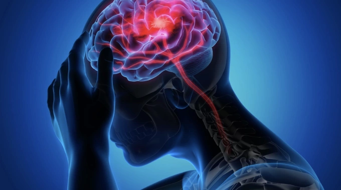 Minh họa một trường hợp đột quỵ não. Ảnh: CDC Mỹ