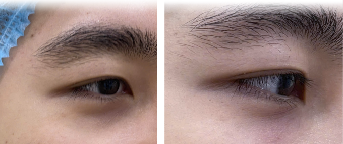 Phần trũng mắt của Thắng đã được cải thiện sau tiêm HA. Ảnh: Phòng khám Đa khoa Tâm Anh Quận 7