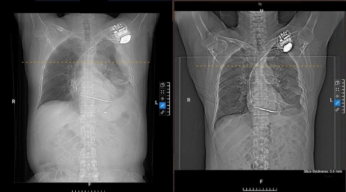 Hình X-quang cho thấy tràn dịch màng phổi bên trái (trái) và sau điều trị (phải) của ông Pirone. Ảnh: Bệnh viện Đa khoa Tâm Anh