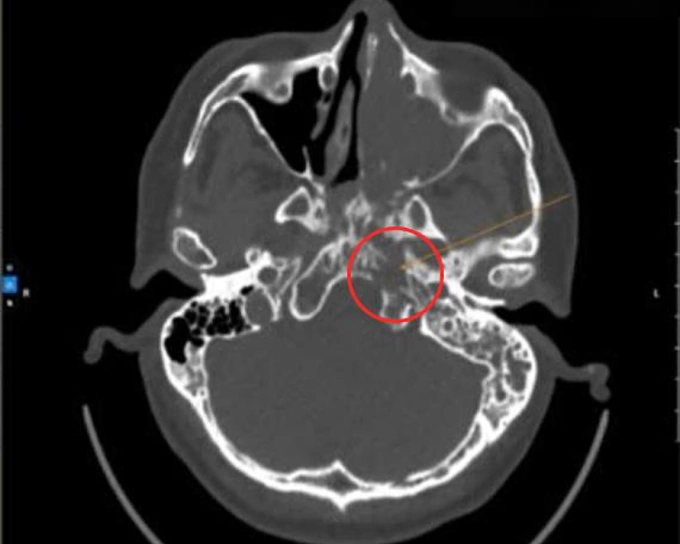 Khối u hốc mũi che lấp vùng vòm họng người bệnh trên ảnh CT. Ảnh: Phòng khám Đa khoa Tâm Anh Quận 7