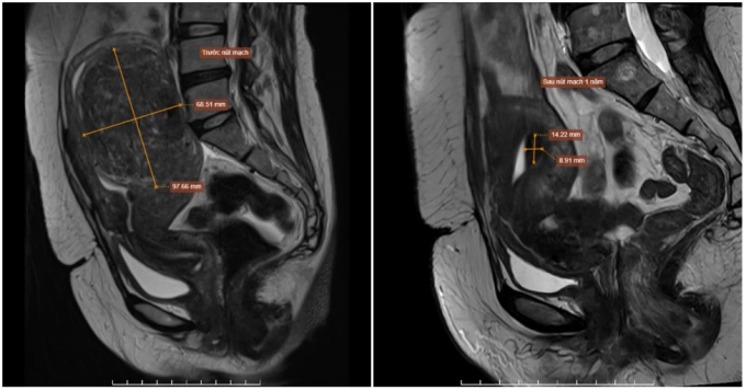 Ảnh khối u của chị Lan thay đổi kích thước trước và sau khi can thiệp. Ảnh: Bệnh viện Đa khoa Tâm Anh