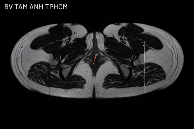 Túi thừa niệu đạo gây nhiễm trùng vùng kín Bác sĩ Liên (giữa) cùng êkíp phẫu thuật cắt túi thừa niệu đạo cho chị Mai. Ảnh: Bệnh viện Đa khoa Tâm Anh