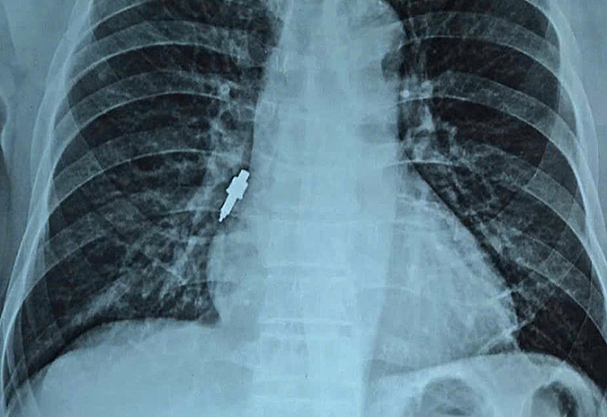 Dụng cụ nha khoa rơi vào đường thở sau khi làm răng Dị vật kim loại nằm sâu trong đường thở. Ảnh: Bệnh viện cung cấp