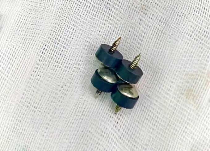 Bé 2 tuổi nuốt 4 đinh nam châm Bốn viên đinh nam châm được bác sĩ gắp ra từ ổ bụng của bé trai. Ảnh: Hùng Lê