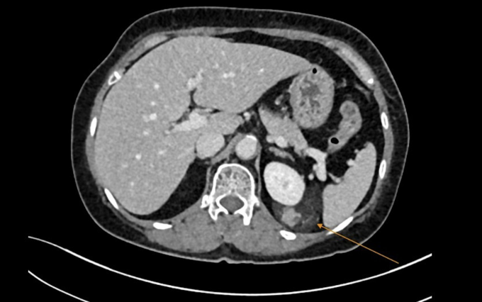 Robot phẫu thuật cắt u bao quanh thận Vị trí khối u cơ mỡ của bà Kim. Ảnh: Bệnh viện Đa khoa Tâm Anh