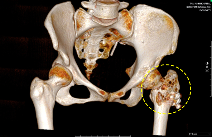 Bất ngờ gãy xương đùi mới biết mắc u tế bào khổng lồ Ảnh chụp CT cho thấy chỏm đùi trái chị Lan tiêu xương nặng do u tế bào khổng lồ. Ảnh: Bệnh viện Đa khoa Tâm Anh