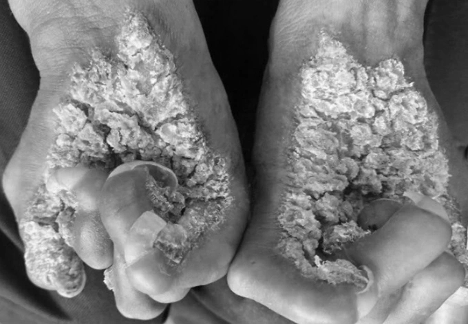 Người đàn ông mắc hội chứng 'người cây' Bàn tay anh Sơn trước khi điều trị. Ảnh: Bác sĩ cung cấp