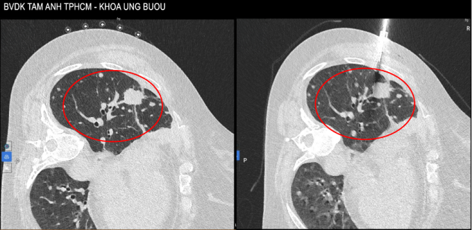 Hai lần đổi phác đồ điều trị ung thư phổi giai đoạn 4 Hình ảnh CT vào tháng 10/2025 thấy u tăng kích thước lên 4 cm và các tổn thương rải rác xung quanh. Ảnh: Bệnh viện Đa khoa Tâm Anh