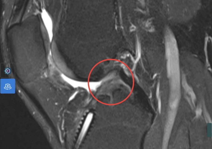 Tái tạo dây chằng sau hai lần đứt Kết quả chụp MRI cho thấy dây chằng chéo trước đã đứt hoàn toàn. Ảnh: Bệnh viện Đa khoa Tâm Anh