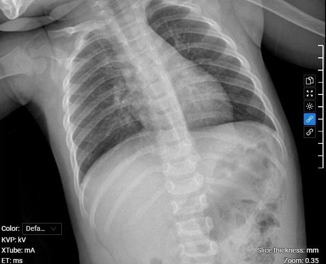 Bé một tuổi suy hô hấp do nhiễm virus hợp bào Kết quả chụp X-quang cho thấy phổi bé Hiền bị ứ khí, gây khó thở, khò khè. Ảnh: Bệnh viện Đa khoa Tâm Anh