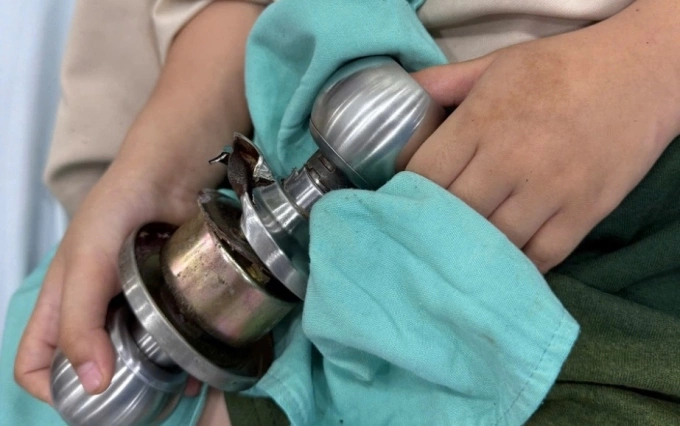 Bác sĩ phá ổ khóa cửa giải cứu ngón tay bé 5 tuổi Bệnh nhi đến viện với ngón tay cái kẹt trong ổ khóa. Ảnh: Bệnh viện cung cấp