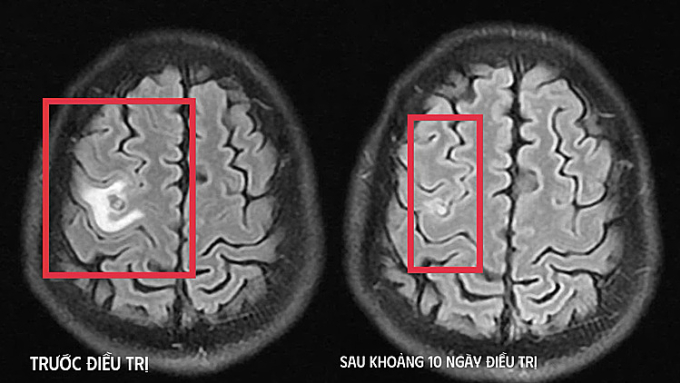 Sán làm tổ trong não khiến người đàn ông co giật Hình ảnh chụp chiếu trước và sau khi điều trị. Ảnh: Bệnh viện cung cấp