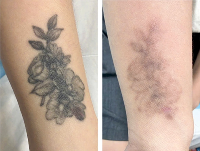 Xóa xăm bằng laser - Báo VnExpress Sức khỏe Hình xăm của chị Mai mờ đi đáng kể sau 9 lần xóa bằng laser pico. Ảnh: Bệnh viện Đa khoa Tâm Anh