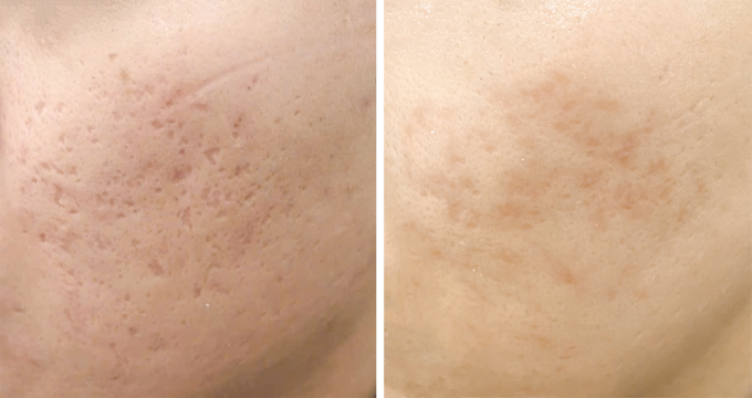 Kết hợp ba phương pháp trị sẹo rỗ mặt Vùng da của anh Vũ đã phẳng khoảng 60% sau một lần tách đáy sẹo và điều trị bằng công nghệ RF. Ảnh: Phòng khám Đa khoa Tâm Anh Quận 7