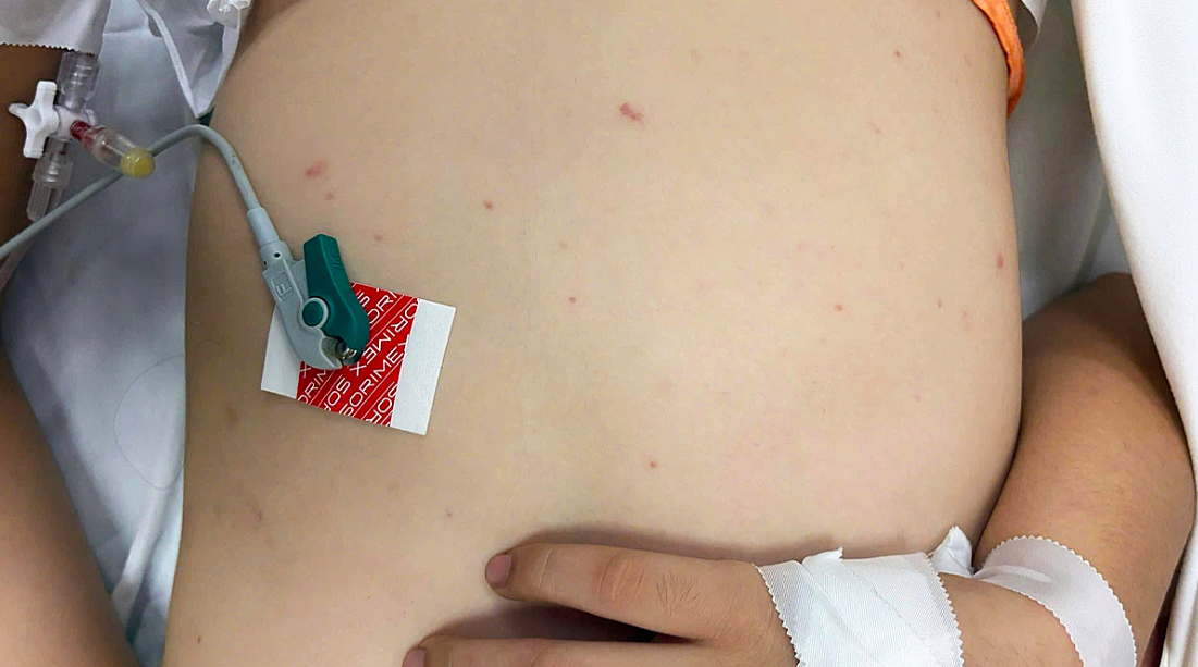 Dấu hiệu mắc não mô cầu - căn bệnh có thể tử vong trong 24 giờ