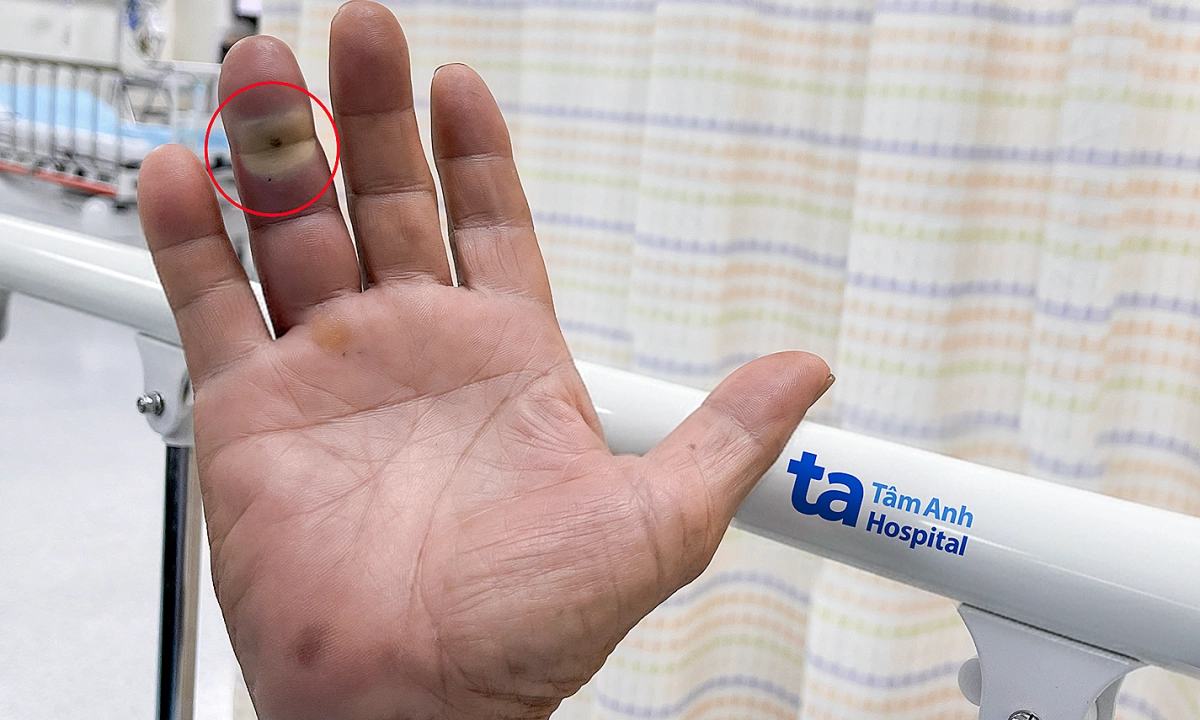 Vết thương chó cắn nhiễm trùng mới biết mắc bệnh tiểu đường