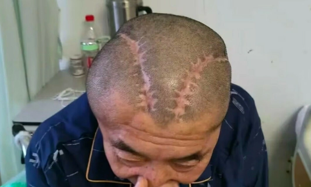 Bệnh nhân xuất huyết não phải, bác sĩ mổ nhầm não trái