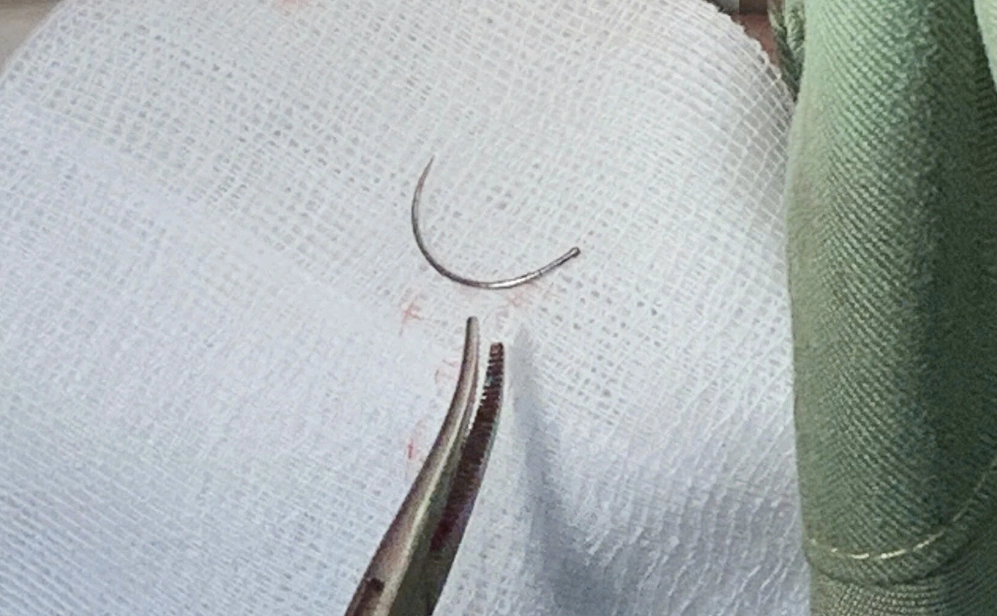 Người phụ nữ sống chung với kim khâu ở vùng kín suốt 11 năm