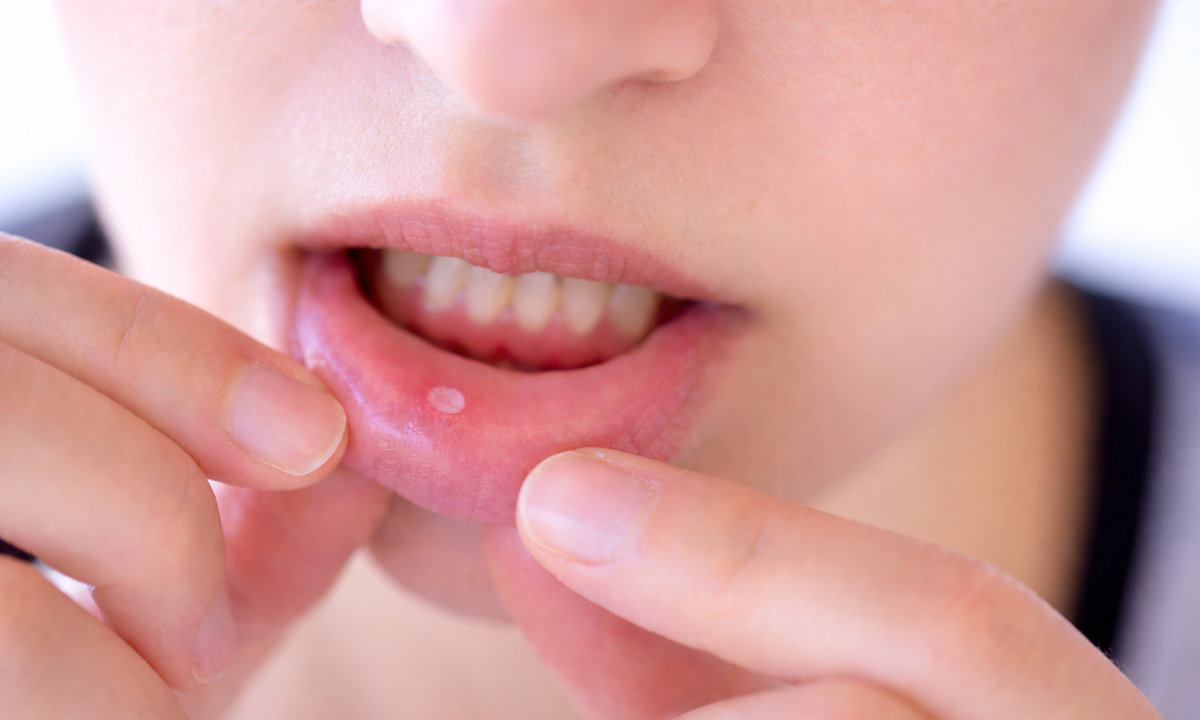 6 dấu hiệu ở miệng có thể cảnh báo thiếu chất