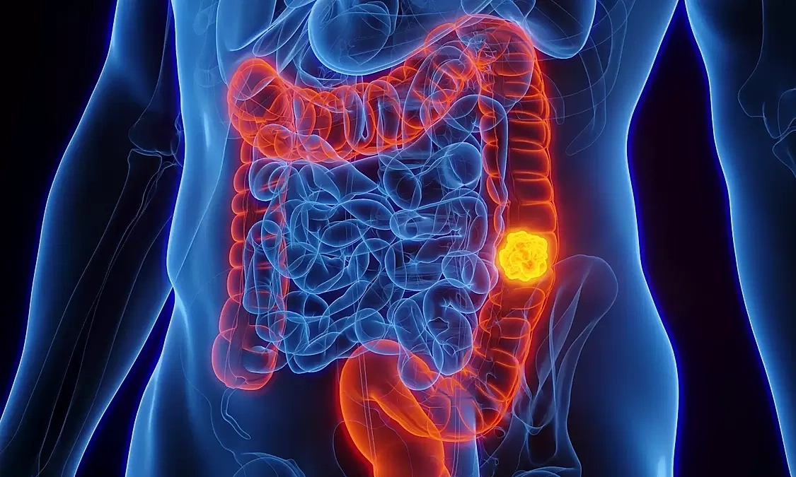 Phát hiện ung thư đại tràng từ dấu hiệu sụt cân