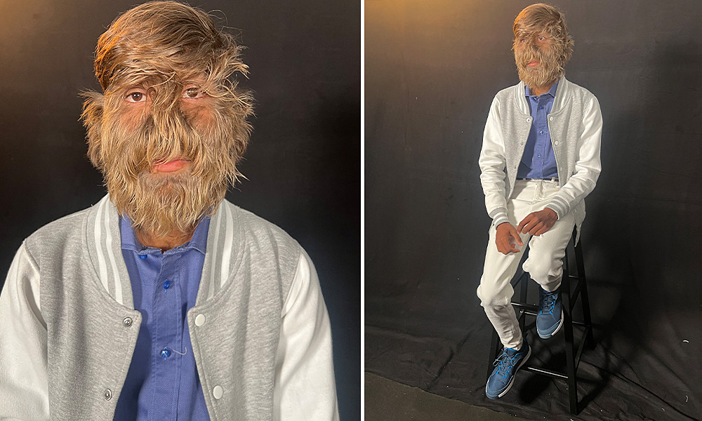 Hội chứng khiến chàng trai có hơn 200 sợi lông trên mỗi cm2 mặt