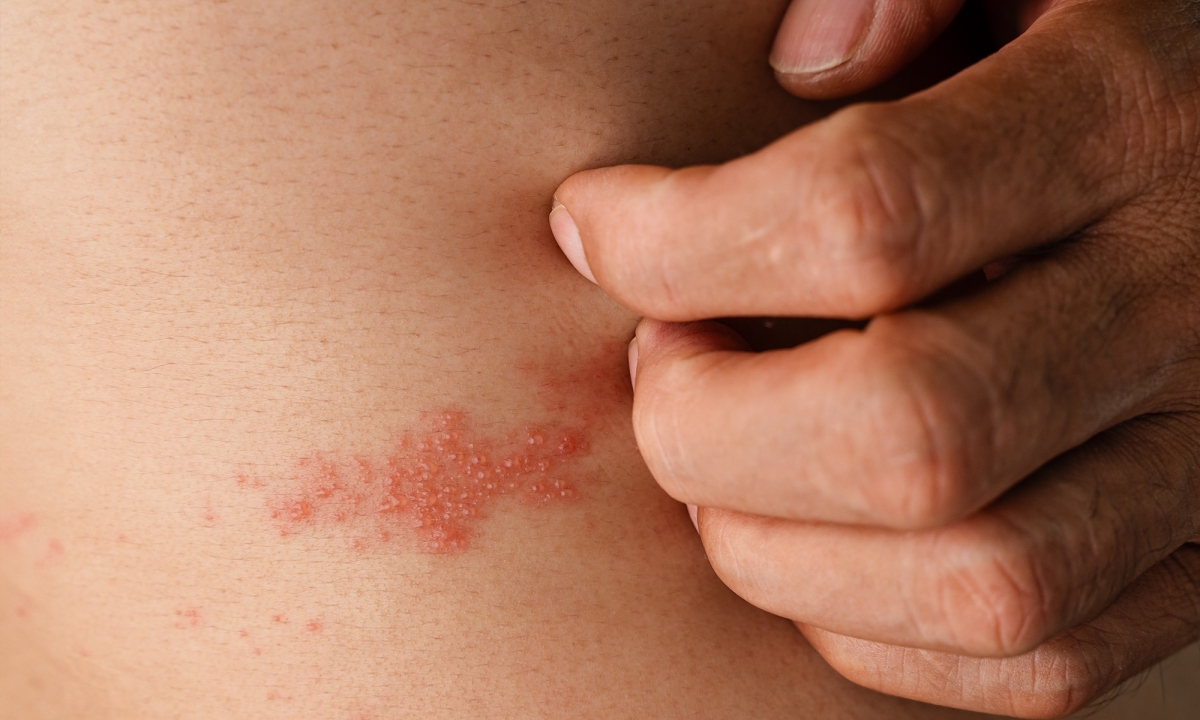 Ba lần mắc zona thần kinh trong hai năm