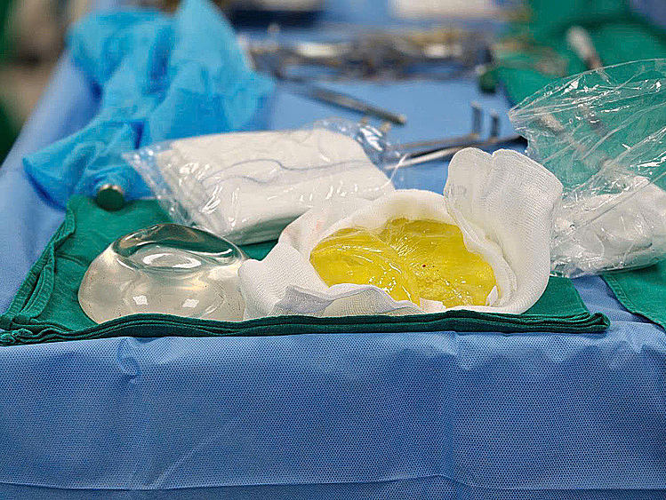 Túi ngực vỡ một năm mới biết