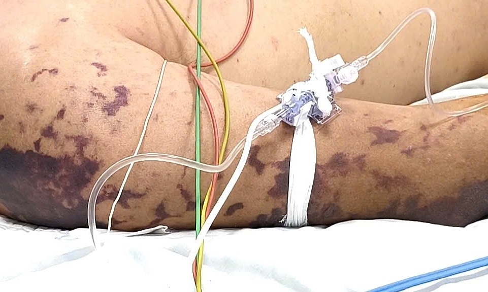 Những thắc mắc thường gặp về não mô cầu