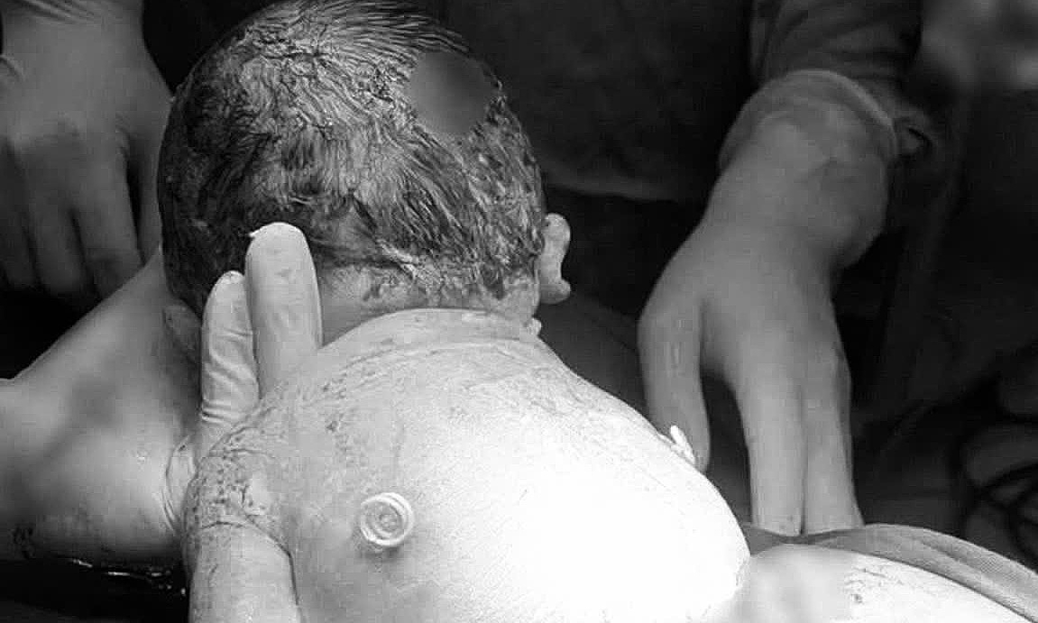 Em bé chào đời với 'đôi cánh nhỏ' trên lưng