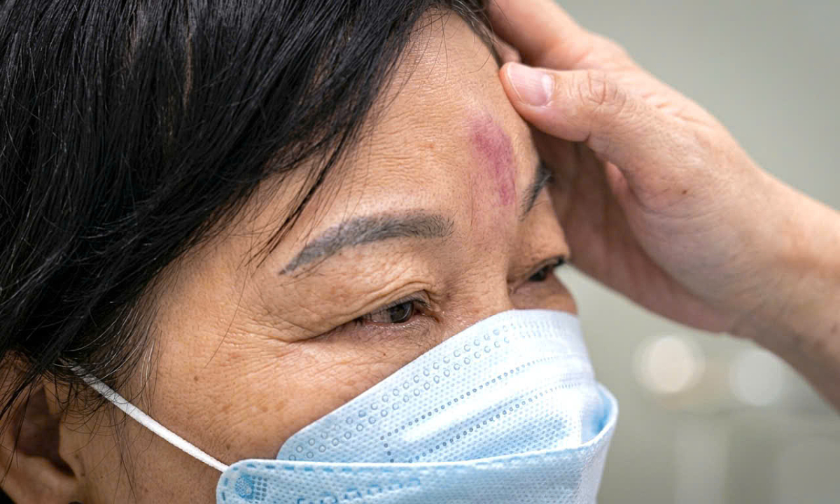 Tiêm filler sai có thể mù mắt vĩnh viễn sau vài phút