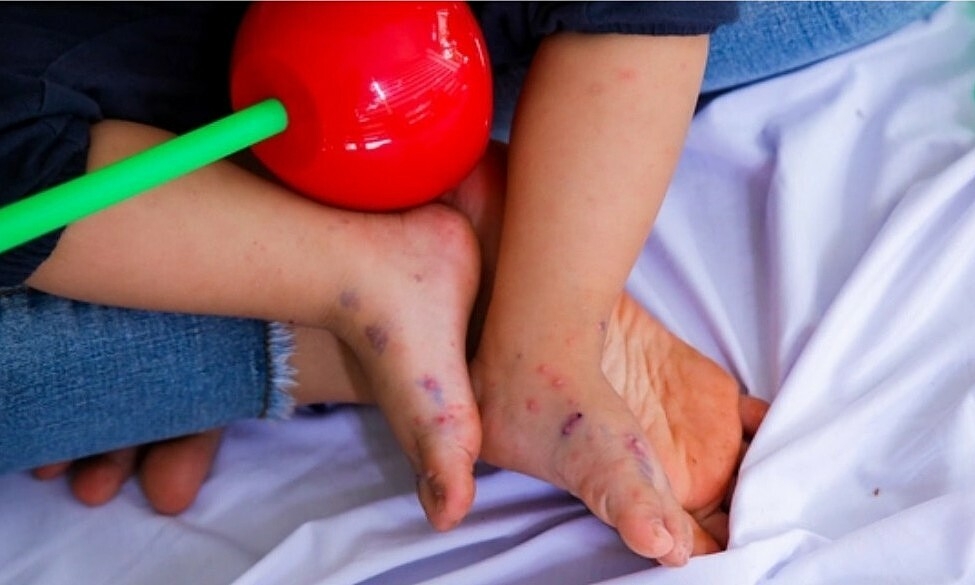 Bệnh tay chân miệng có vaccine chưa?