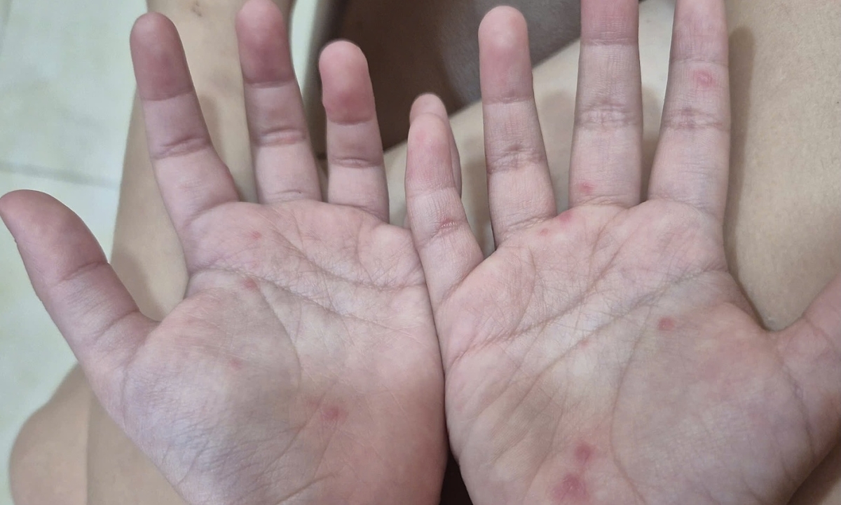 Dấu hiệu cảnh báo trẻ bệnh tay chân miệng trở nặng