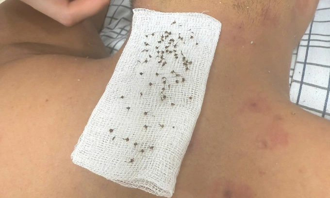 Các bác sĩ loại bỏ nọc độc do ong đốt trên da người bệnh. Ảnh: Bệnh viện cung cấp