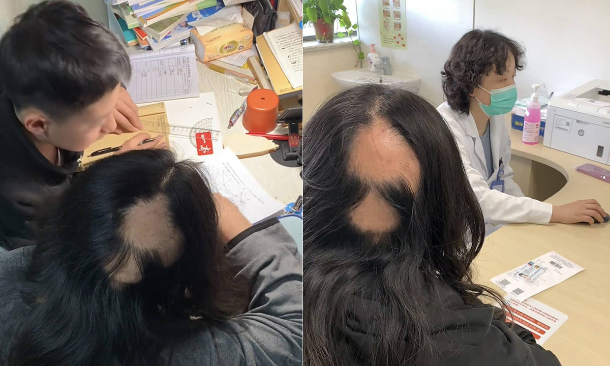 Mẹ hói cả mảng lớn vì thức đêm kèm con học