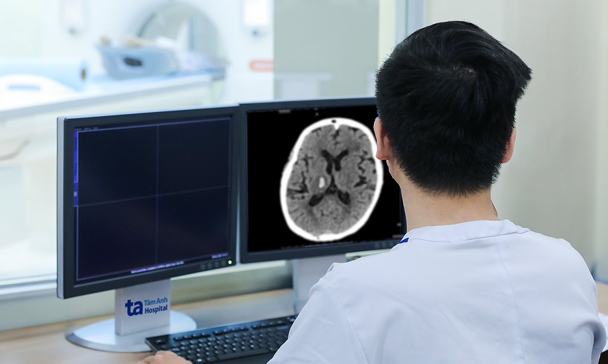 Xuất huyết não do tăng huyết áp