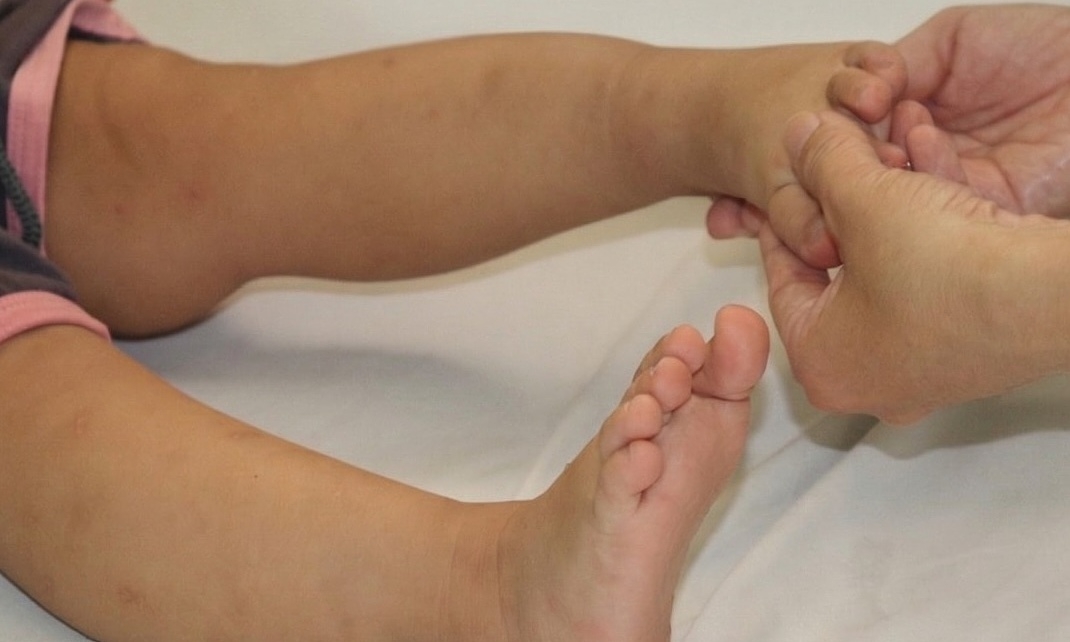 Trẻ nhiễm EV71 triệu chứng tay chân miệng mờ nhạt nhưng nặng nhanh