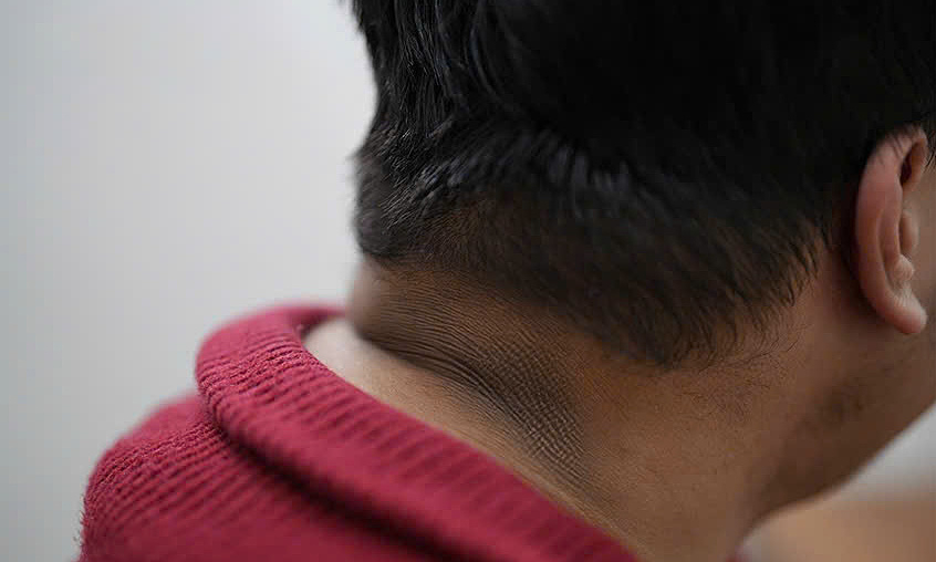 Da cổ, nách sậm màu có phải dấu hiệu tiểu đường?