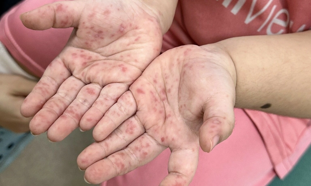 Vì sao trẻ tái mắc tay chân miệng nhiều lần?