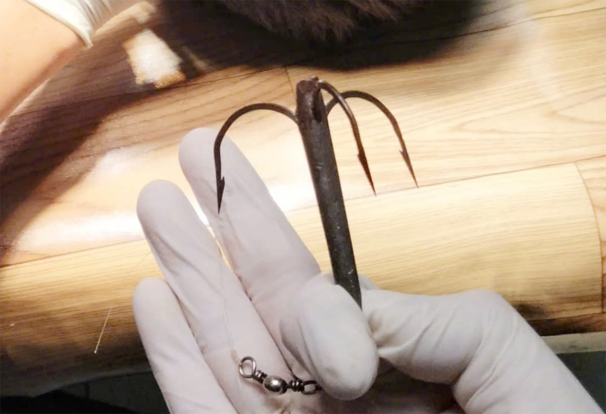 Thiếu niên bị lưỡi câu ba tiêu cắm vào đỉnh đầu