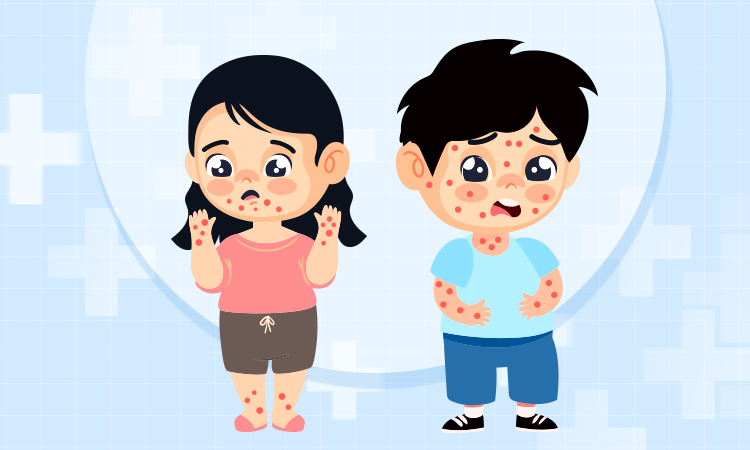 Triệu chứng nặng bệnh tay chân miệng khác thủy đậu thế nào