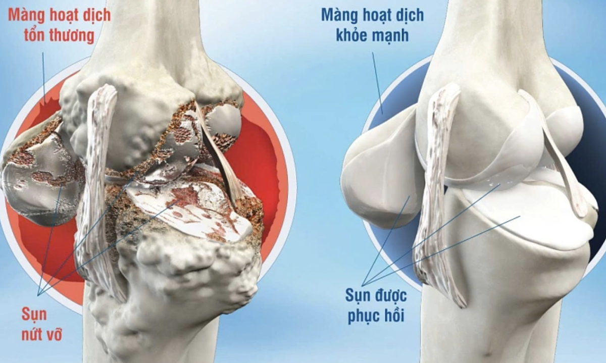 5 khớp trên cơ thể dễ bị thoái hóa