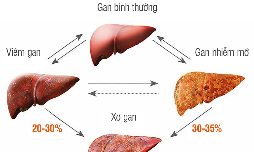 Vì sao gan nhiễm mỡ dễ tiến triển ung thư gan?