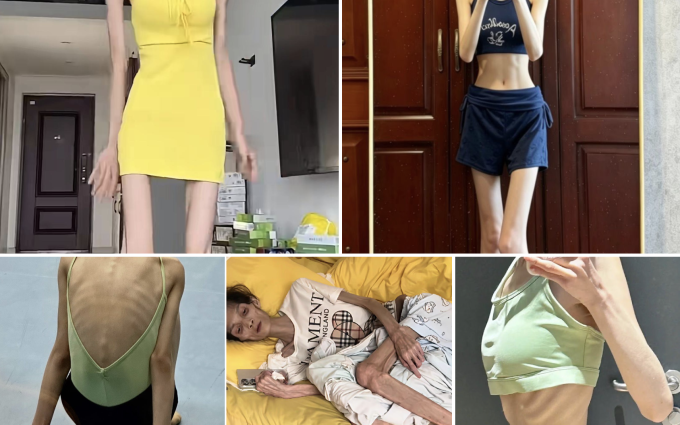 Với chiều cao 1,7 m, cô gái này hiện chỉ nặng 44 kg. Ảnh: ST Headline
