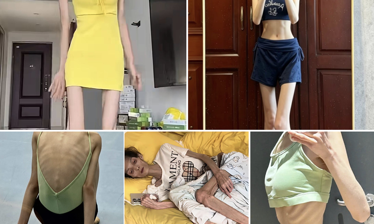 Cô gái 23 tuổi suy kiệt, mất kinh vì tiêm thuốc giảm cân